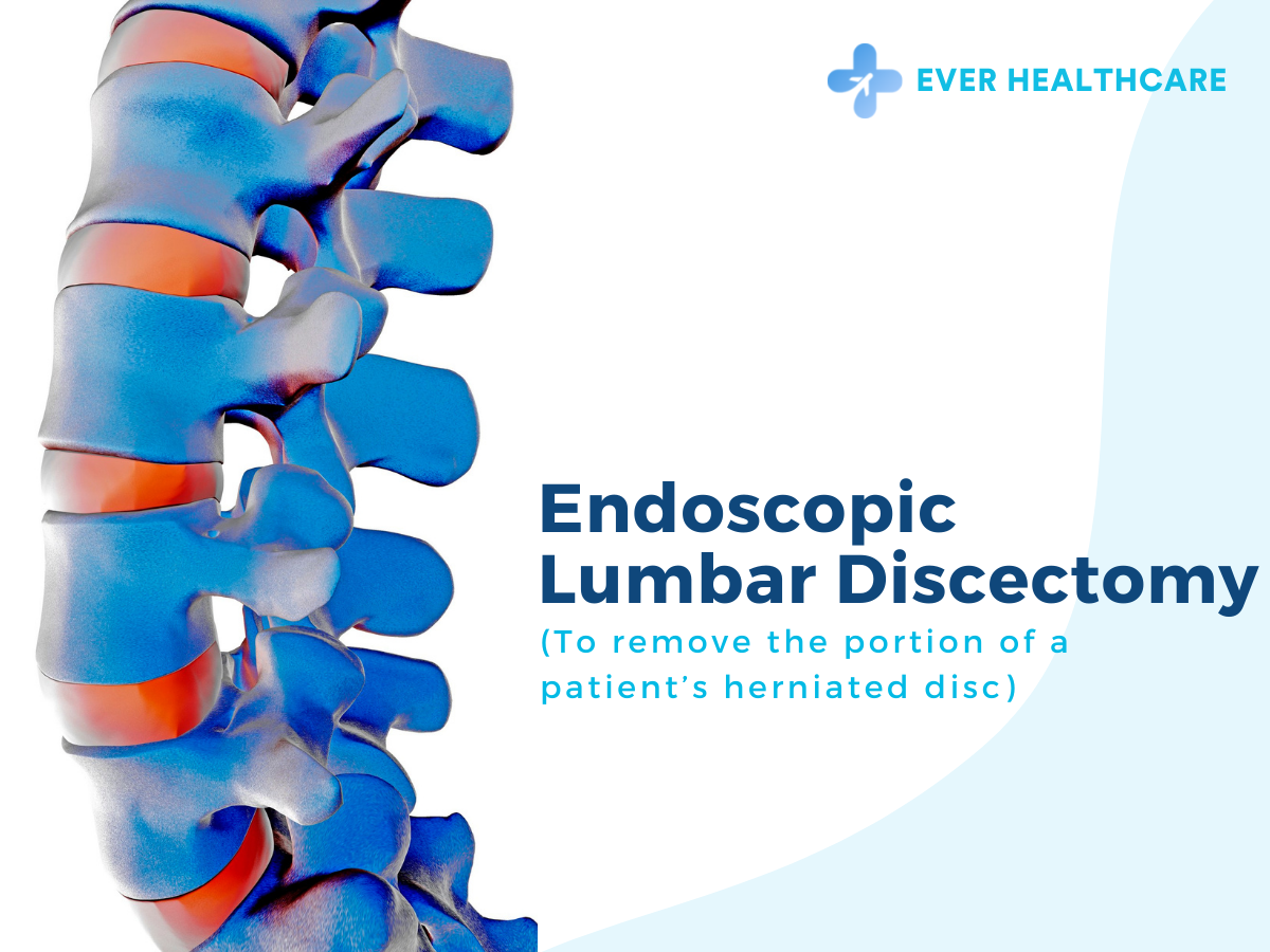 Endoscopic Lumbar Discectomy in Thailand 2023 Compare Price & Reviews